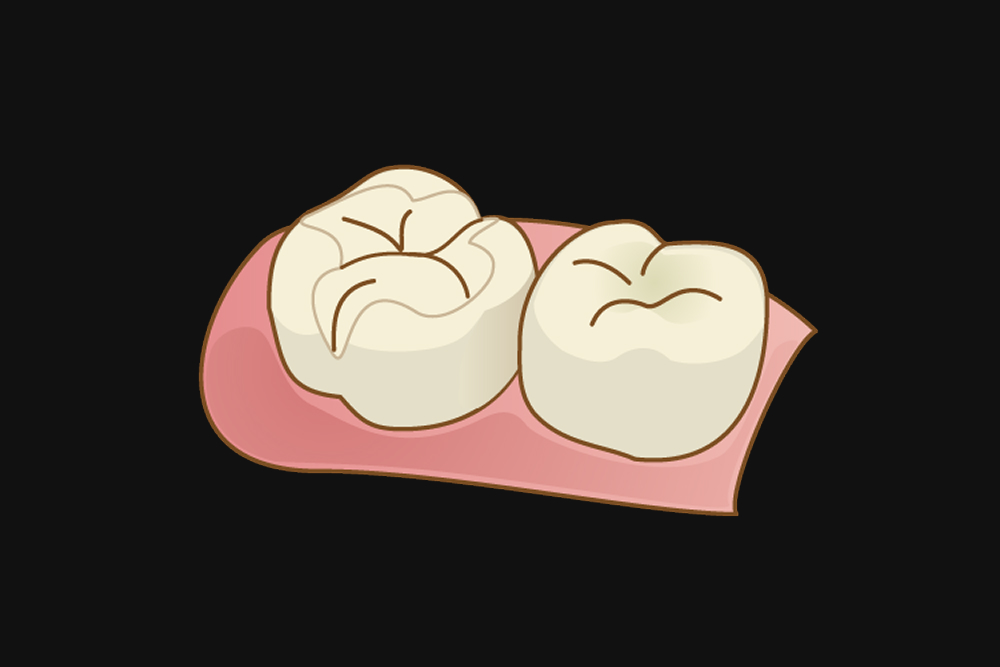 ダイレクトボンディング