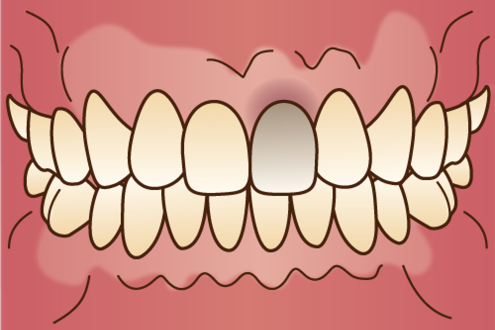 ウォーキングブリーチ